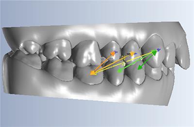 Analysis of Class II Intermaxillary Elastics Applied Forces: An in-vitro Study